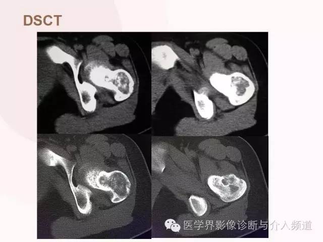 【病例】软骨母细胞瘤2例影像表现与鉴别