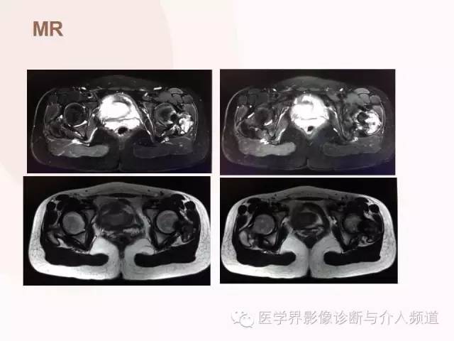【病例】软骨母细胞瘤2例影像表现与鉴别