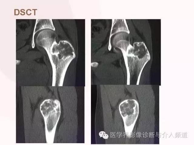 【病例】软骨母细胞瘤2例影像表现与鉴别