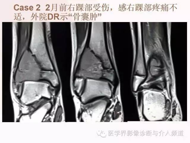 【病例】软骨母细胞瘤2例影像表现与鉴别