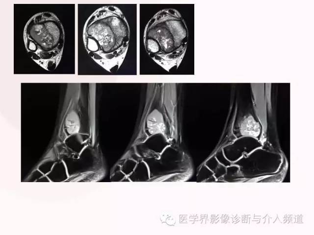 【病例】软骨母细胞瘤2例影像表现与鉴别
