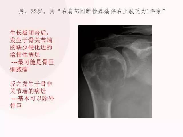 【病例】软骨母细胞瘤2例影像表现与鉴别