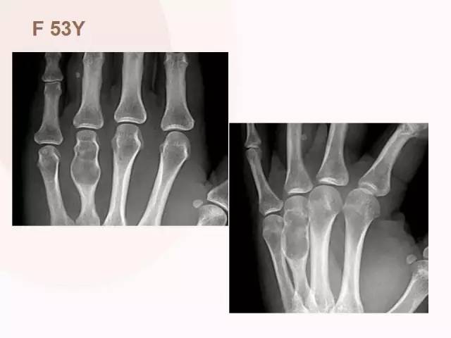 【病例】软骨母细胞瘤2例影像表现与鉴别