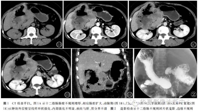 【病例】十二指肠腺鳞癌的影像学表现2例