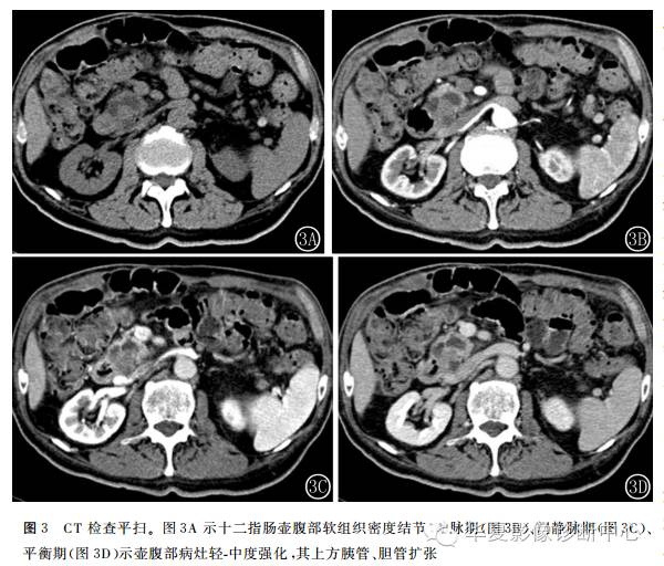【病例】十二指肠腺鳞癌的影像学表现2例 【病例】十二指肠腺鳞癌的影像学表现2例