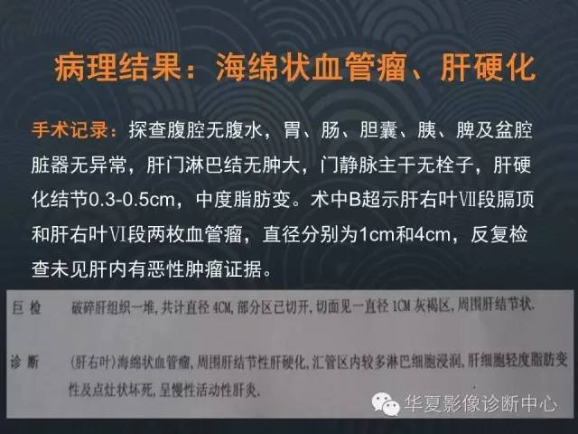 【病例】肝硬化伴海绵状血管瘤1例CT影像表现