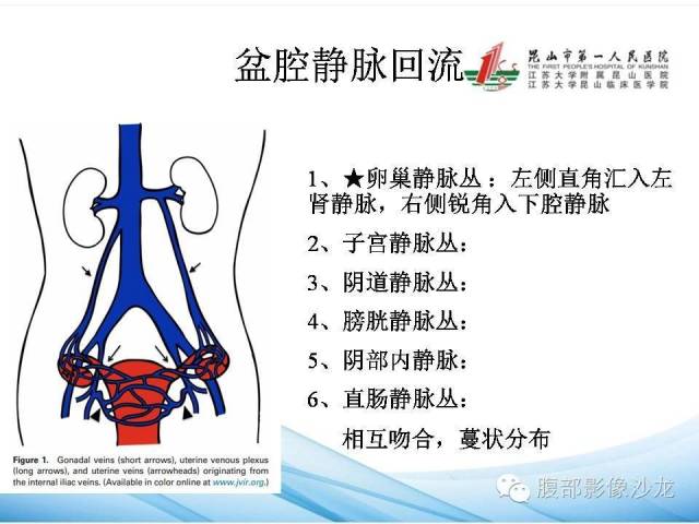 【PPT】盆腔淤血综合征CTA表现 【PPT】盆腔淤血综合征CTA表现