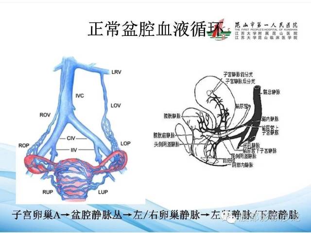 【PPT】盆腔淤血综合征CTA表现 【PPT】盆腔淤血综合征CTA表现