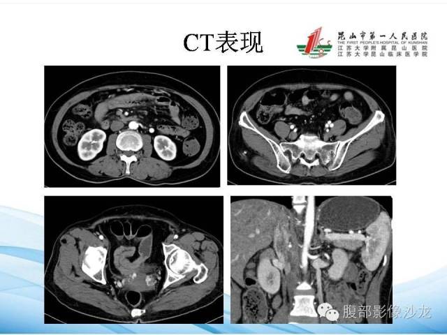 【PPT】盆腔淤血综合征CTA表现 【PPT】盆腔淤血综合征CTA表现