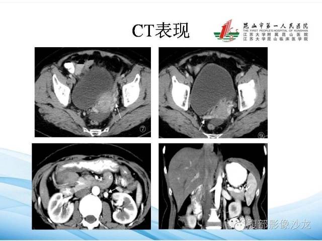【PPT】盆腔淤血综合征CTA表现 【PPT】盆腔淤血综合征CTA表现