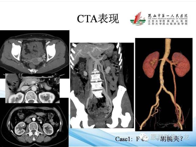【PPT】盆腔淤血综合征CTA表现 【PPT】盆腔淤血综合征CTA表现