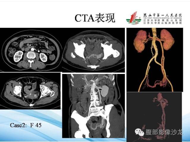 【PPT】盆腔淤血综合征CTA表现 【PPT】盆腔淤血综合征CTA表现
