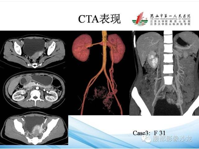 【PPT】盆腔淤血综合征CTA表现 【PPT】盆腔淤血综合征CTA表现