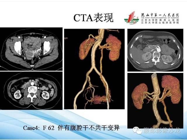 【PPT】盆腔淤血综合征CTA表现 【PPT】盆腔淤血综合征CTA表现