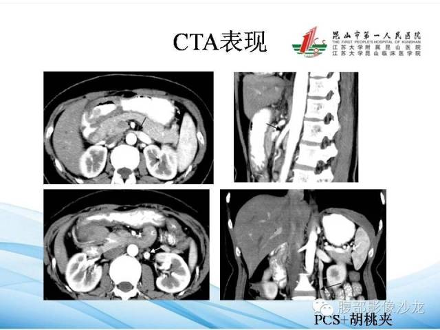 【PPT】盆腔淤血综合征CTA表现 【PPT】盆腔淤血综合征CTA表现