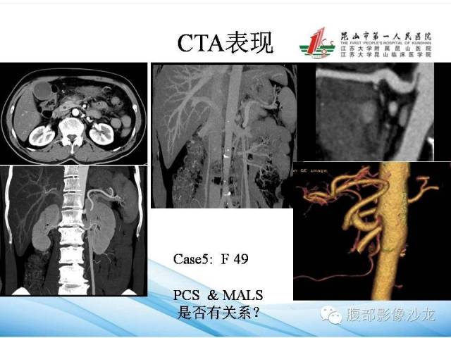 【PPT】盆腔淤血综合征CTA表现 【PPT】盆腔淤血综合征CTA表现