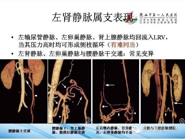 【PPT】盆腔淤血综合征CTA表现 【PPT】盆腔淤血综合征CTA表现