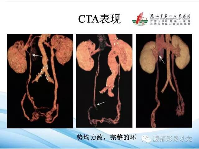 【PPT】盆腔淤血综合征CTA表现 【PPT】盆腔淤血综合征CTA表现