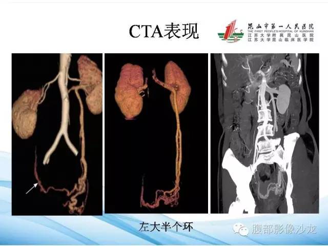 【PPT】盆腔淤血综合征CTA表现 【PPT】盆腔淤血综合征CTA表现