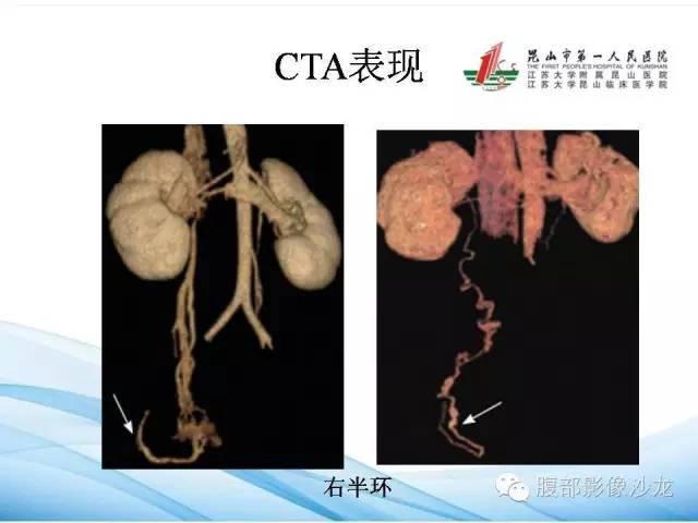【PPT】盆腔淤血综合征CTA表现 【PPT】盆腔淤血综合征CTA表现