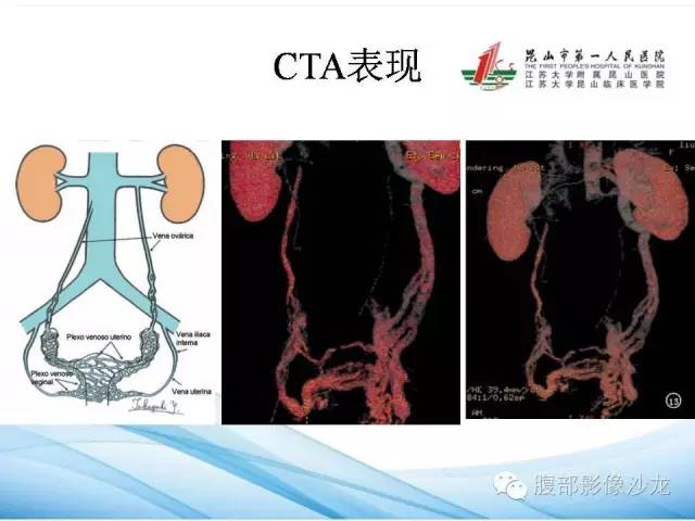 【PPT】盆腔淤血综合征CTA表现 【PPT】盆腔淤血综合征CTA表现