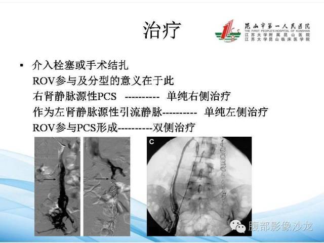 【PPT】盆腔淤血综合征CTA表现 【PPT】盆腔淤血综合征CTA表现