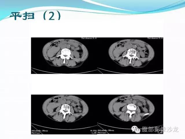 【病例】右肾血管平滑肌脂肪瘤1例CT影像表现