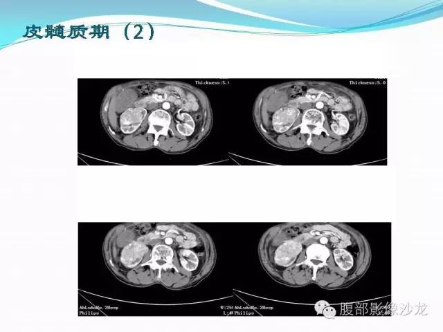 【病例】右肾血管平滑肌脂肪瘤1例CT影像表现