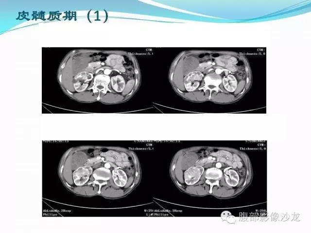 【病例】右肾血管平滑肌脂肪瘤1例CT影像表现