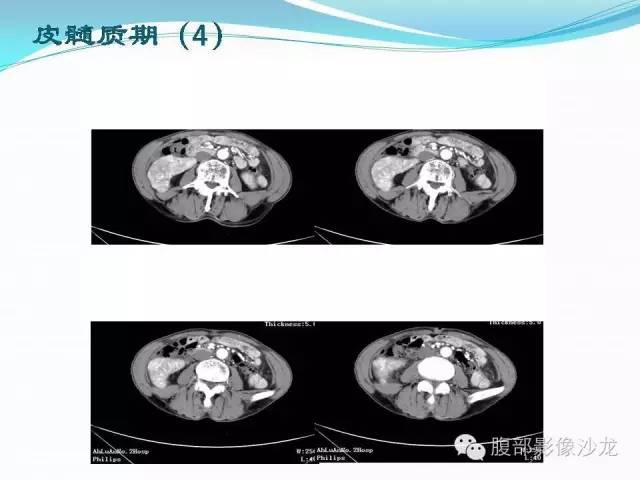 【病例】右肾血管平滑肌脂肪瘤1例CT影像表现