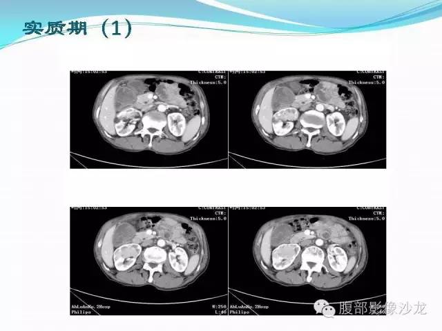 【病例】右肾血管平滑肌脂肪瘤1例CT影像表现