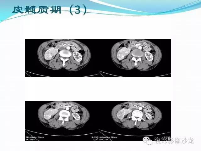 【病例】右肾血管平滑肌脂肪瘤1例CT影像表现
