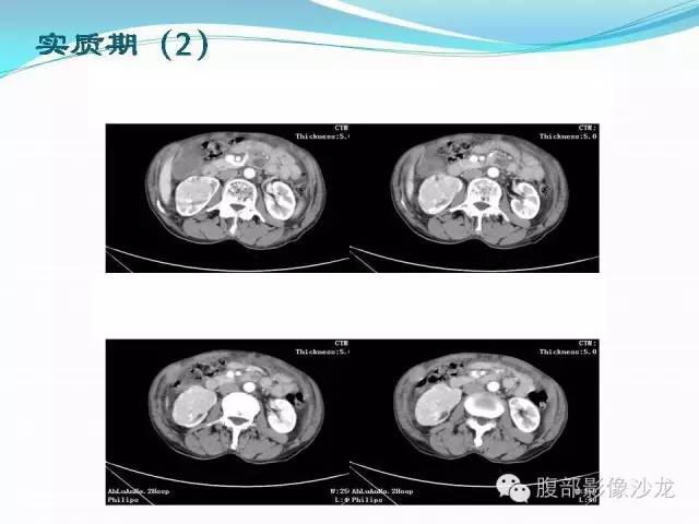 【病例】右肾血管平滑肌脂肪瘤1例CT影像表现
