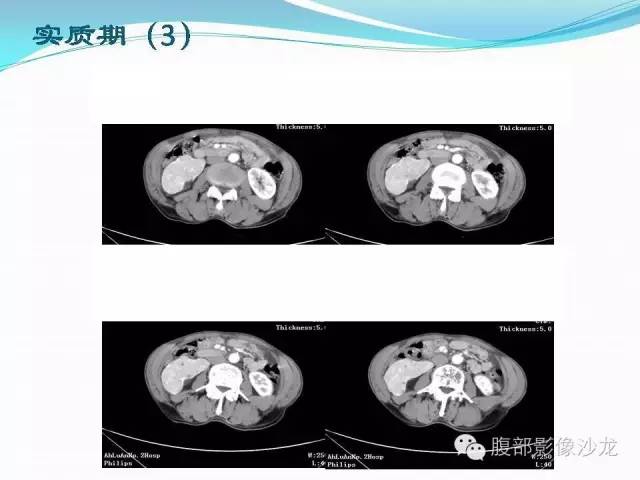 【病例】右肾血管平滑肌脂肪瘤1例CT影像表现