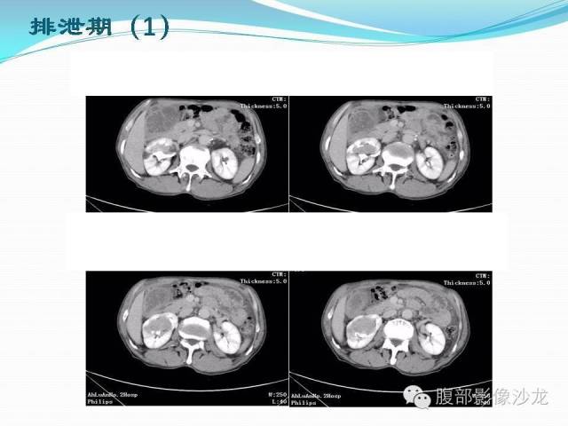 【病例】右肾血管平滑肌脂肪瘤1例CT影像表现