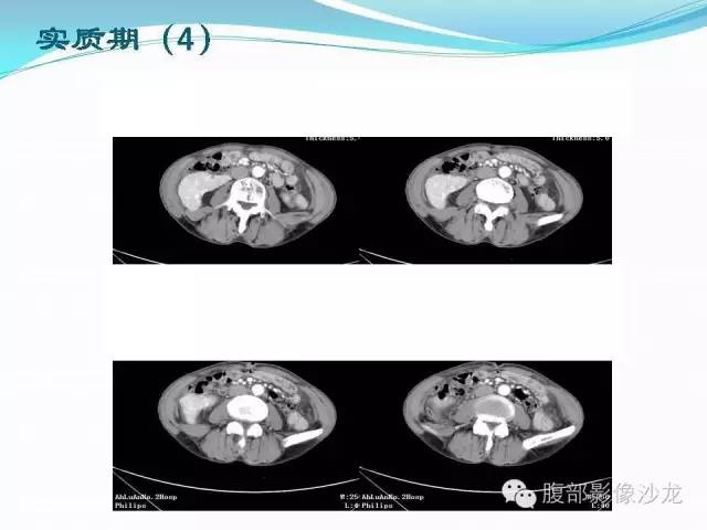 【病例】右肾血管平滑肌脂肪瘤1例CT影像表现