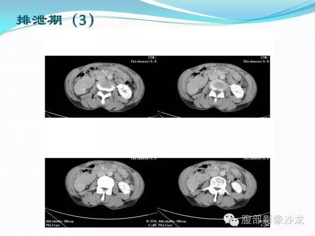 【病例】右肾血管平滑肌脂肪瘤1例CT影像表现