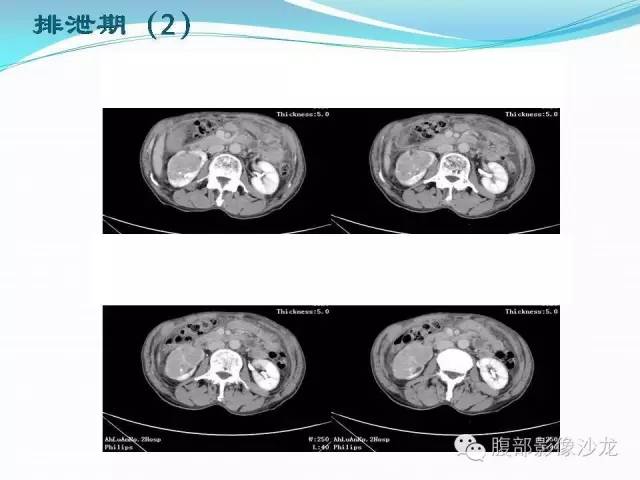 【病例】右肾血管平滑肌脂肪瘤1例CT影像表现