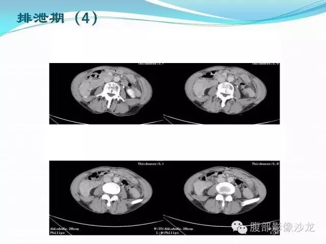 【病例】右肾血管平滑肌脂肪瘤1例CT影像表现
