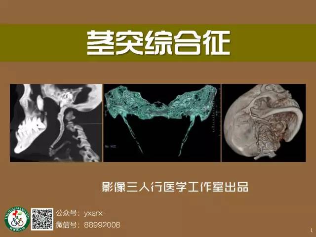 【PPT】茎突综合征