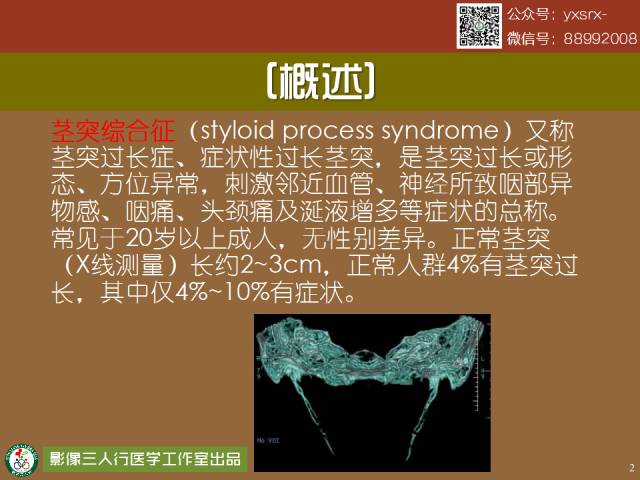 【PPT】茎突综合征