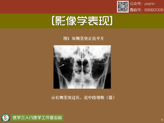 【PPT】茎突综合征