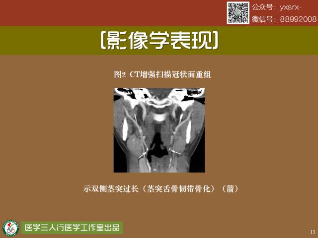 【PPT】茎突综合征