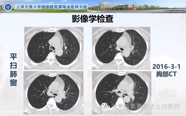 【病例】气管内乳头状瘤1例CT影像表现