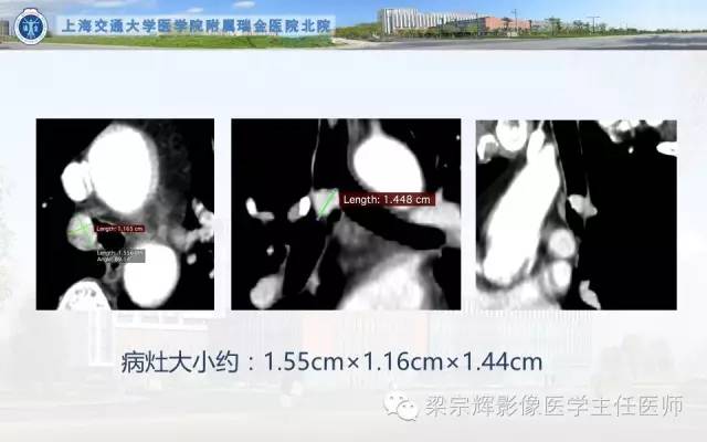 【病例】气管内乳头状瘤1例CT影像表现