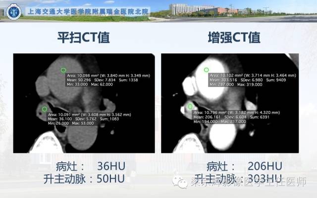 【病例】气管内乳头状瘤1例CT影像表现