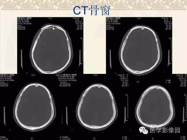 【病例】成人血管母1例CT及MR影像表现