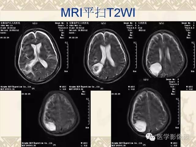 【病例】成人血管母1例CT及MR影像表现