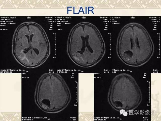 【病例】成人血管母1例CT及MR影像表现