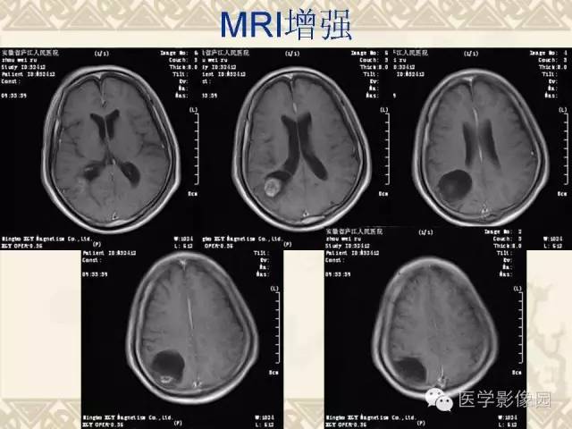 【病例】成人血管母1例CT及MR影像表现
